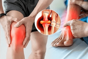 Az Icexin gél felvitele a térdízület és a láb területére