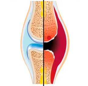 Az egészséges és kopott ízület szerkezete a porcszövet és az ízületi folyadék megjelölésével