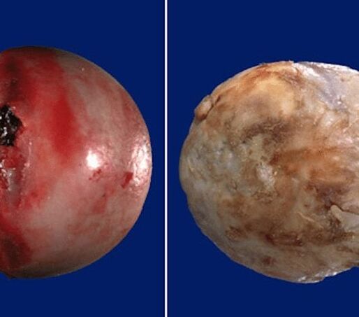 Egészséges és arthrosis által érintett porcfelület