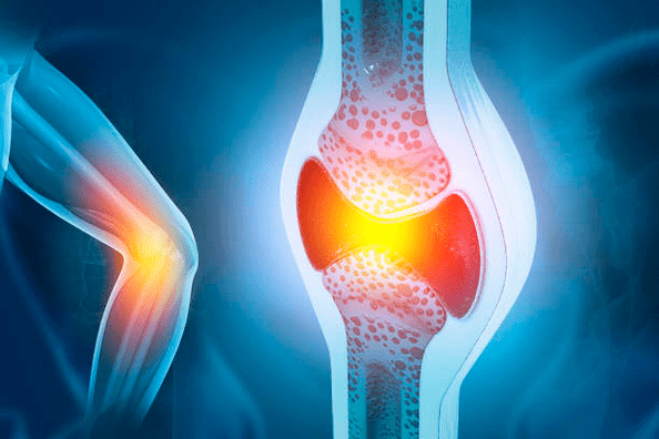 Ízületi betegségek megelőzése